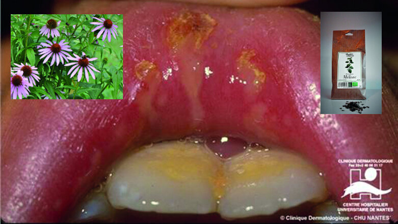 La place de la phytothérapie dans le traitement des lésions buccales