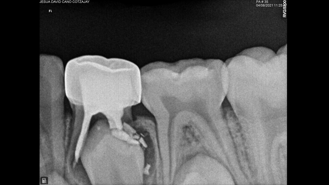 Fig. 12: Control at 36 months showing the normal eruption process despite the slow resorption of the zinc oxide eugenol.