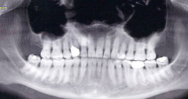 Terapia farmacologica durante blocco acuto dell’articolazione temporo-mandibolare