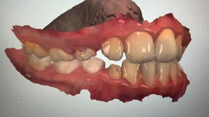 Utilizzo dello scanner intraorale in ortodonzia