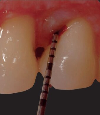 Fig. 13a - Follow up a un anno.