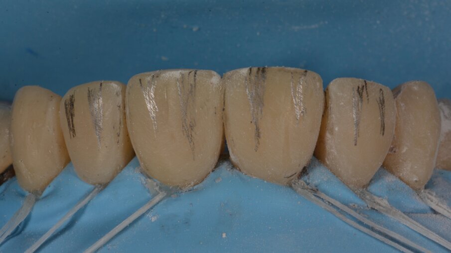 Zodra de primaire anatomie is aangebracht kunnen we de secundaire anatomie aanbrengen in de vorm van oppervlakkige mamelons. Deze worden ook eerst aangebracht met potlood en dan ingekerfd met een traag draaiende diamantboor.