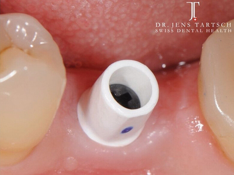 Fig. 11: Abutment. (Photo: Jens Tartsch, DMD)