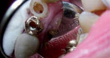 Kořen ve tvaru písmene S – rizika této velké výzvy v endodoncii