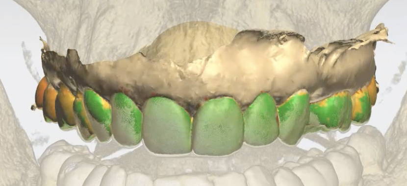 Fig. 6_L’allineamento tra impronta intraorale e Dicom a basso dosaggio.