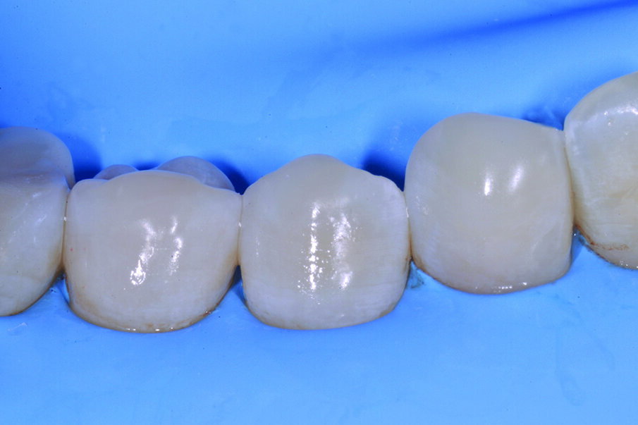 Figg. 6-9_Le superfici occlusali erose e/o abrase vengono ricostruite con strati sottili di smalto composito Enamel Plus HRi Bio Function. 