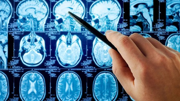 Infezioni dentali possono provocare degli aneurismi cerebrali