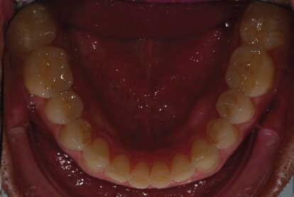 Fig. 3: Intraoral
photograph prior to treatment, occlusal view of mandible.