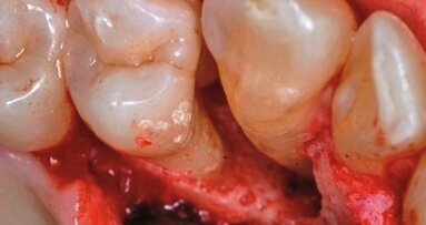 Zastosowanie laserów w ubytkach kostnych w obrębie przyzębia