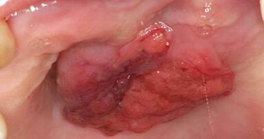Papillary squamous cell carcinoma of the hard palate: Report of a rare case affecting the oral cavity