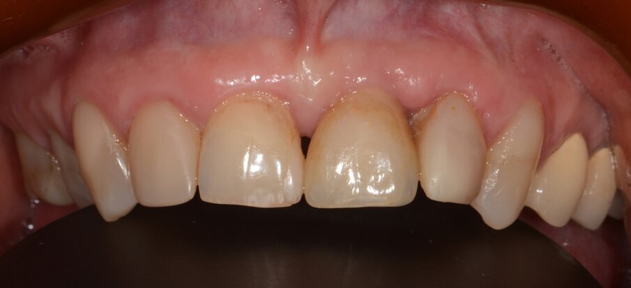Fig. 20: Situation 1.5 years post-op. No sign of inflammation.