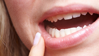 Neue S2k-Leitlinie zum Thema Aphthen veröffentlicht Neue S2k-Leitlinie zum Thema Aphthen veröffentlicht