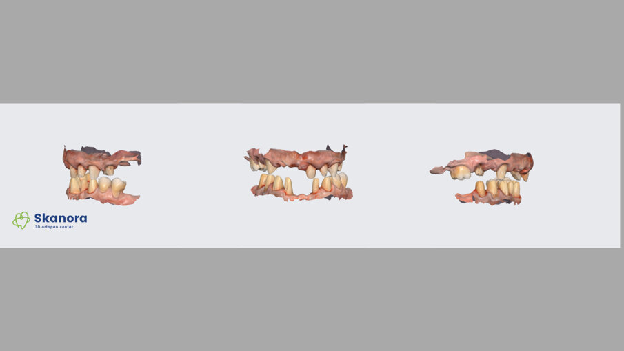 Slika 2 Intraoralni sken za izradu privremenih mostova (dr Dejan Stajčić)