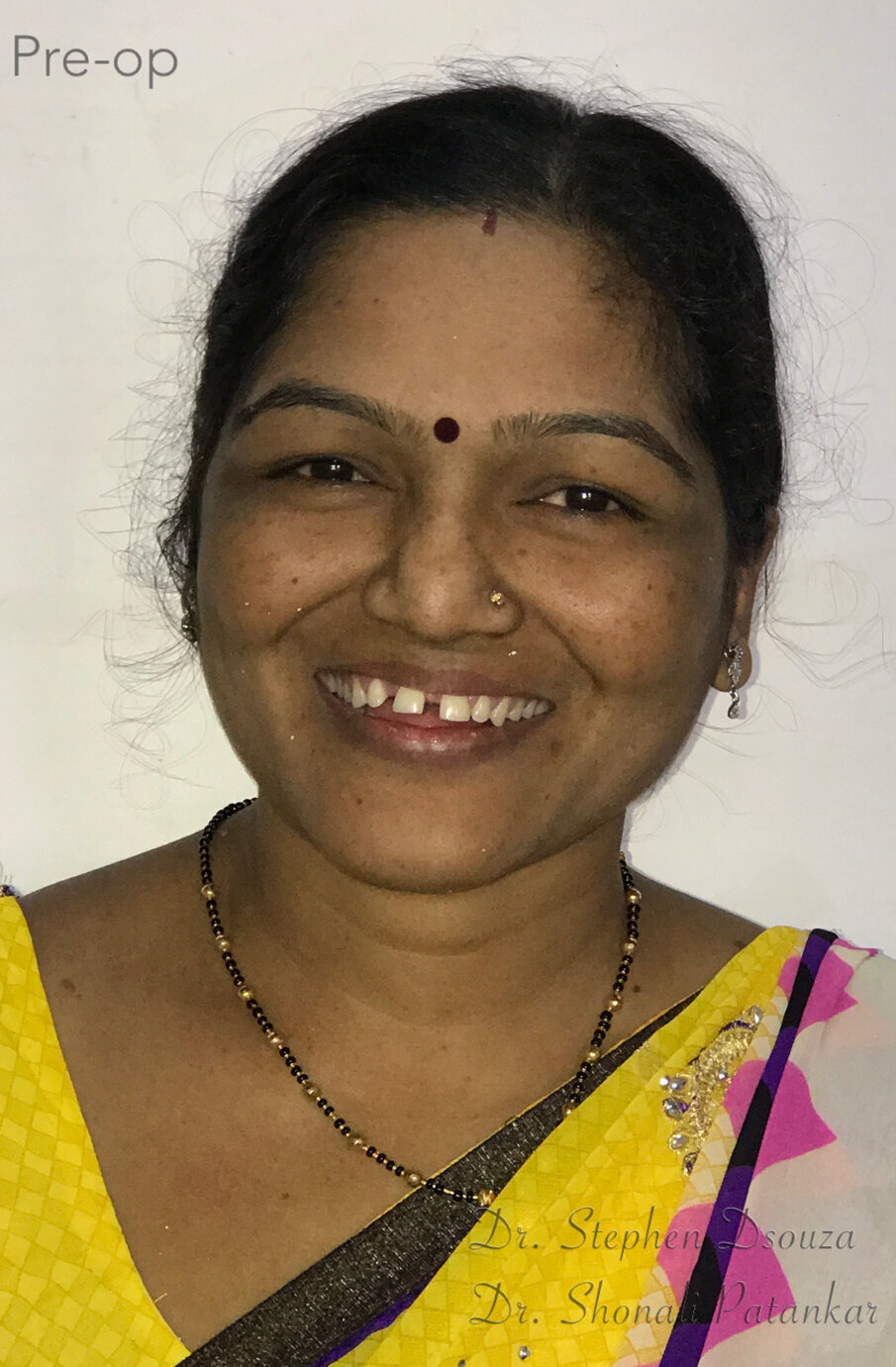 Fig. 1: Pre-operative smile.