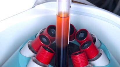 Możliwości zastosowania PRP i PRF w sterowanej regeneracji tkanek w chirurgii stomatologicznej