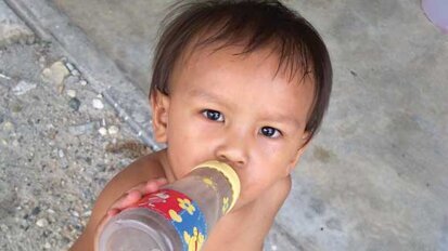 Caries accounts for one-third of day surgeries for preschoolers