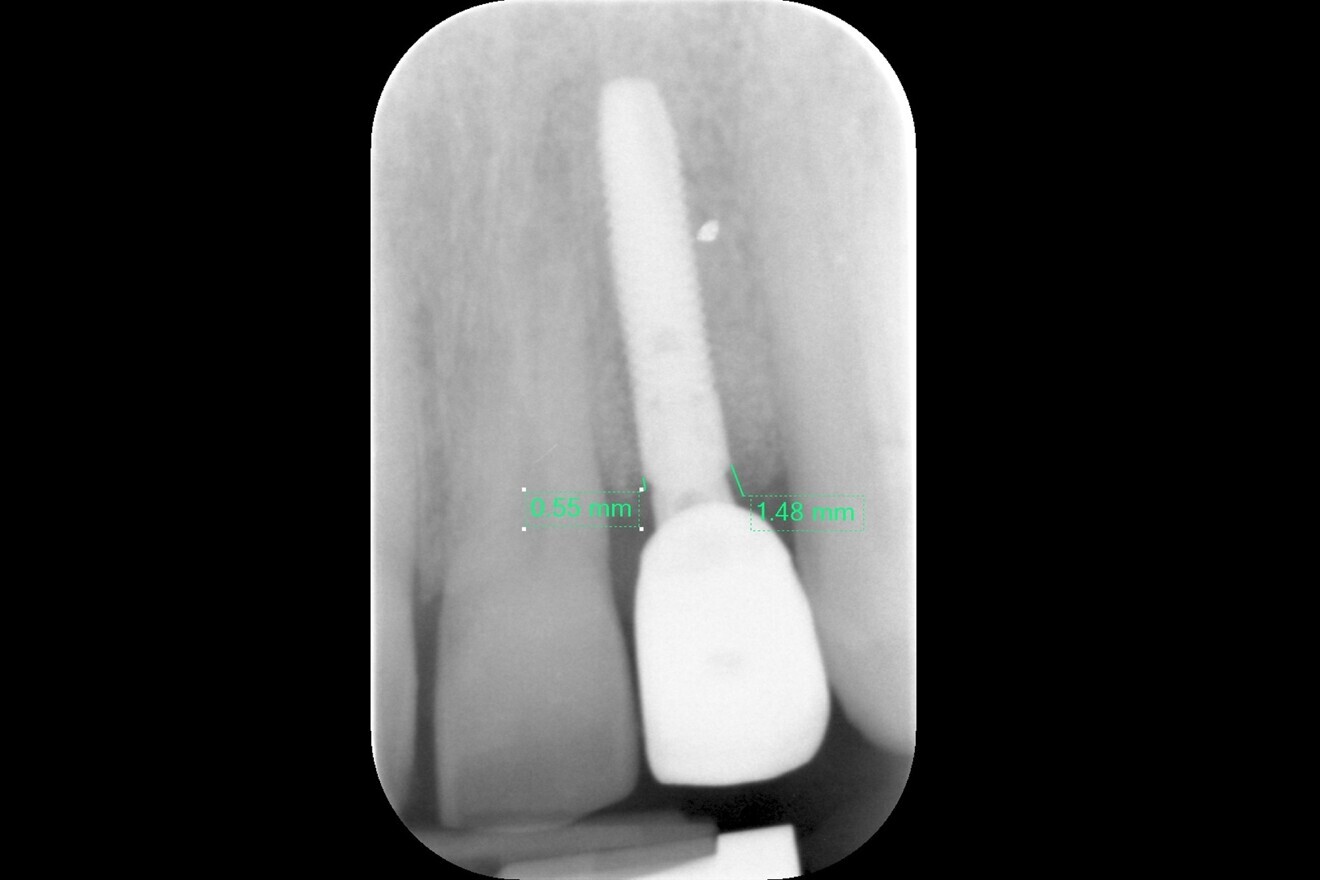 Fig. 19: Radiograph taken 11 months after remedial surgery and guided bone regeneration around the implant, demonstrating good graft confinement and consolidation.