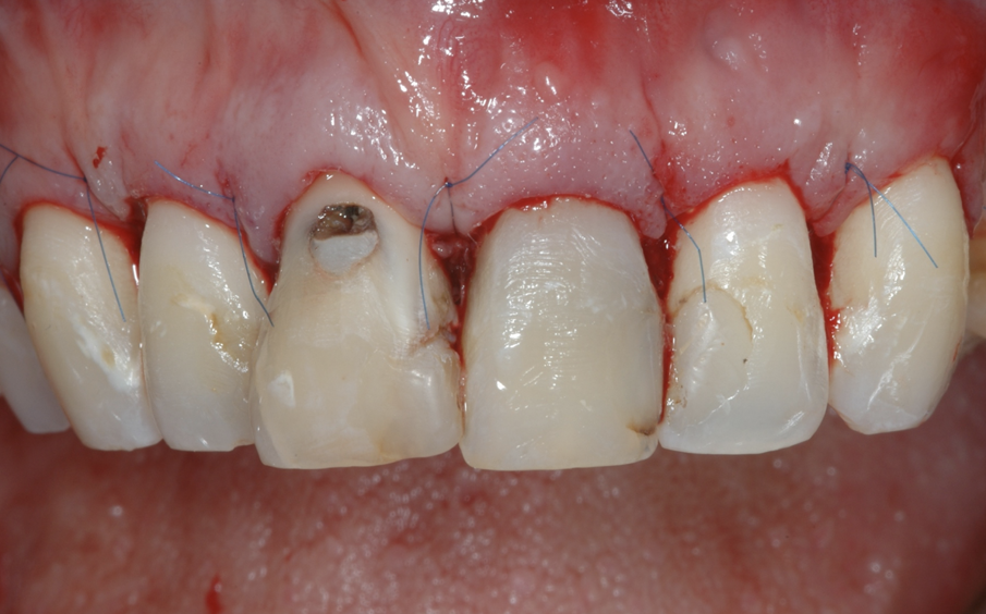 Fig. 7 - La sutura al termine dell’intervento.