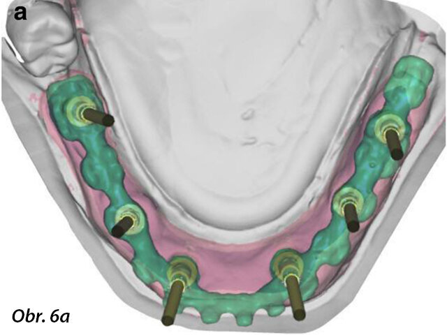 CAD návrh základní konstrukce provizorní fixní náhrady (a) a zvětšené snímky rozhraní mezi CAD základní konstrukcí a prefabrikovanými titanovými abutmenty (b, c).