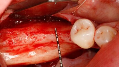 Výzkumník z Maďarska představí unikátní techniku augmentace kosti „sausage technique“