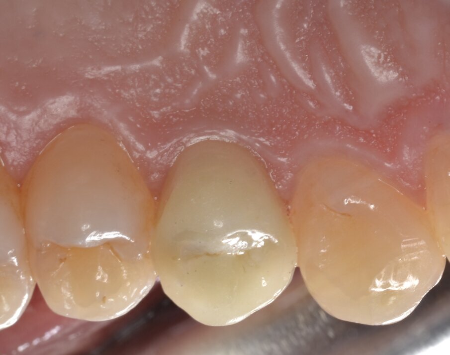 Fig. 25 - Corona protesica definitiva in zirconia stratificata (visione orale).