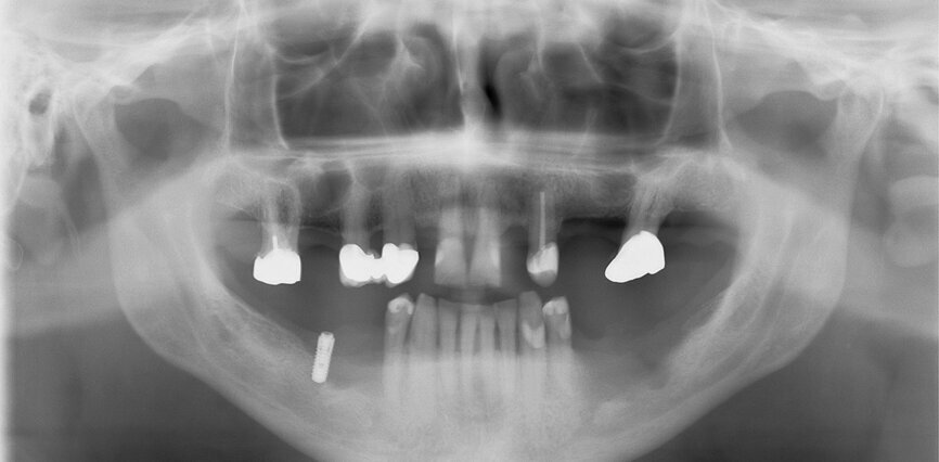 Fig. 1: Initial situation: severe bone defects and implant in situ. 