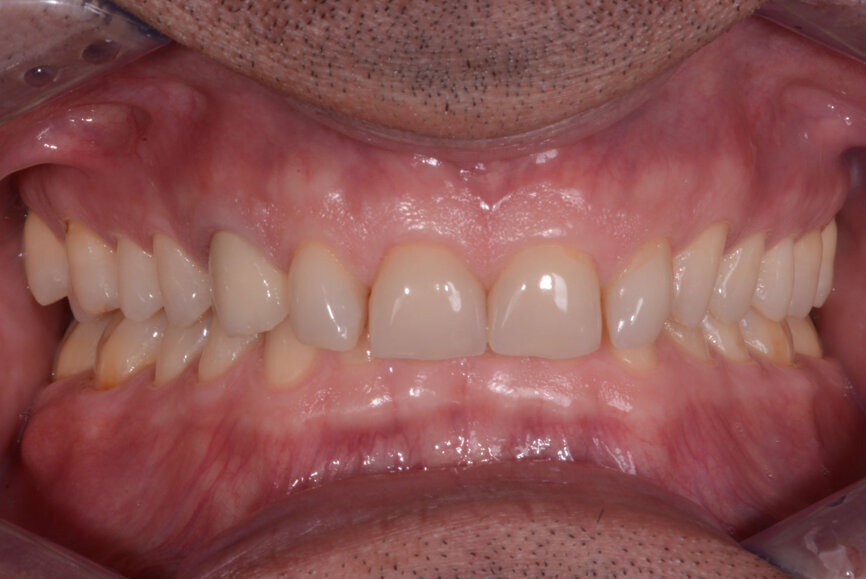 Fig. 7: Two years later, prior to treatment (2017).