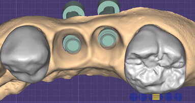 Profili gengivali in protesi: approccio full-digital