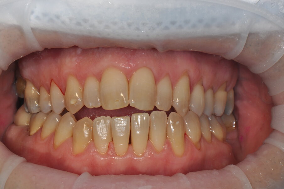 Fig. 7 - Fotografia frontale scattata dopo la seduta di igiene professionale mediante l’utilizzo del sistema Airflow® Prophylaxis Master (EMS®) con polvere a base di eritritolo® e ablatore a ultrasuoni con punta perioslim (PS, EMS®).