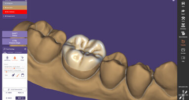 Exocad veröffentlicht ChairsideCAD 3.1 Rijeka mit neuen Features für Restaurationen in einer Sitzung