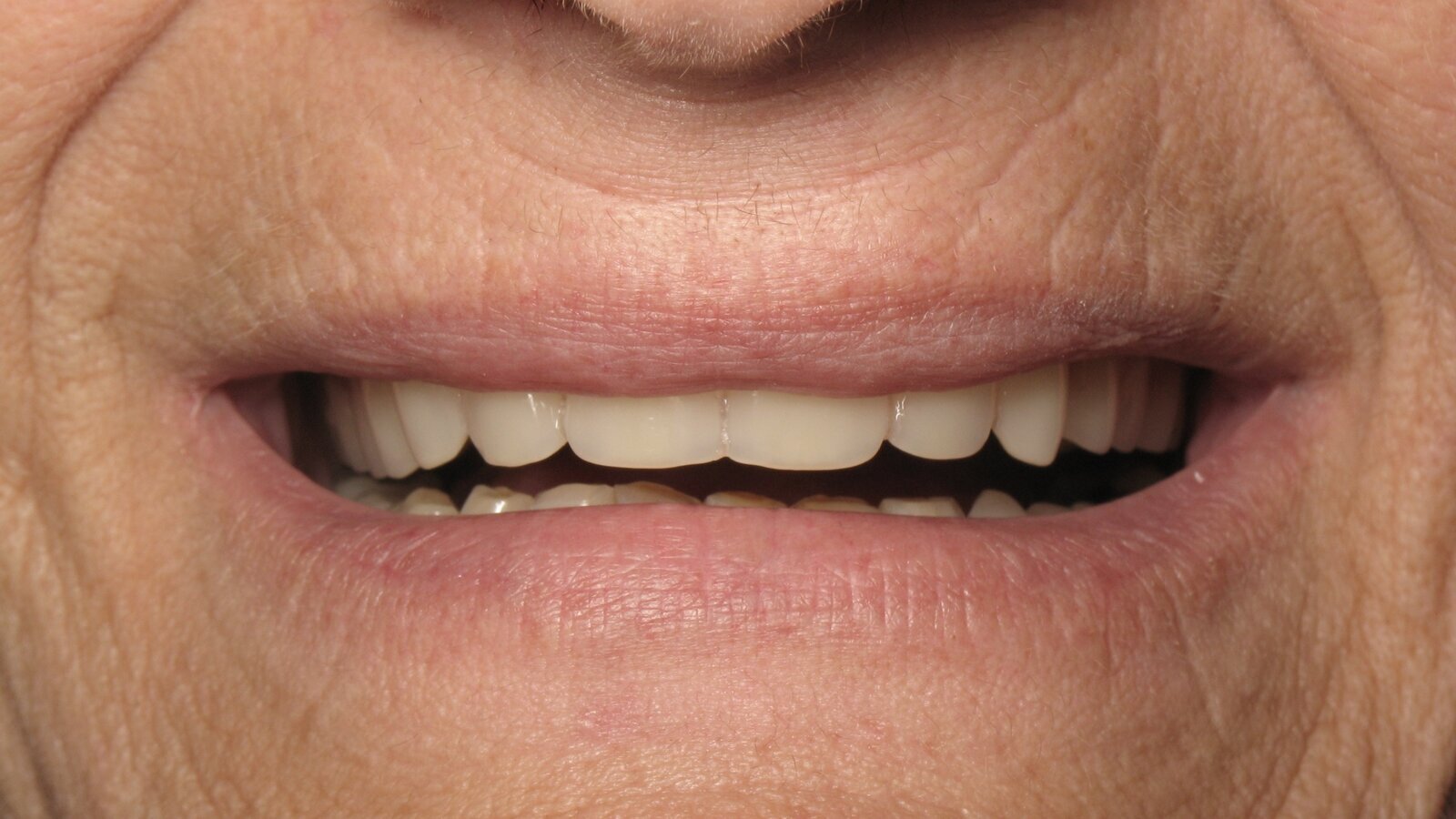 ¿Sabes cómo copiar y pegar una prótesis completa? (1)