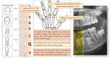 ¿Cuándo iniciar el tratamiento de Ortodoncia?