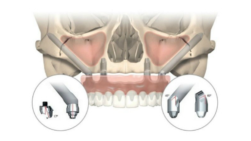 Nobel Biocare – NobelZygoma