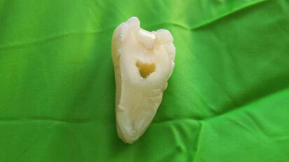 Nový materiál pro rekonstrukci zubů nabízí vylepšení oproti plnivům na bázi akrylátů