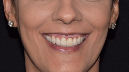 Estética dinámica en la sonrisa gingival con Botox