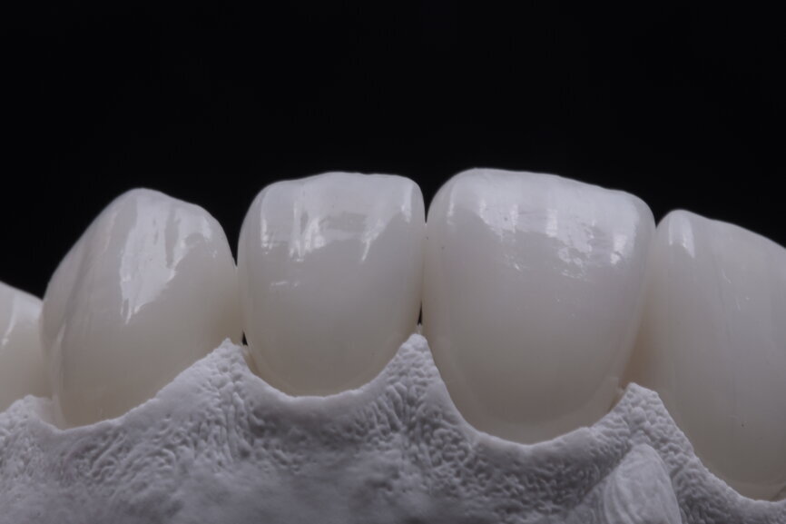 Fig. 75: Glazed ceramic veneers on the plaster model.