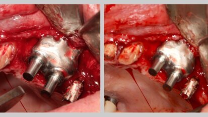 Cierre de comunicación oro-sinusal con placa de titanio personalizada 3D