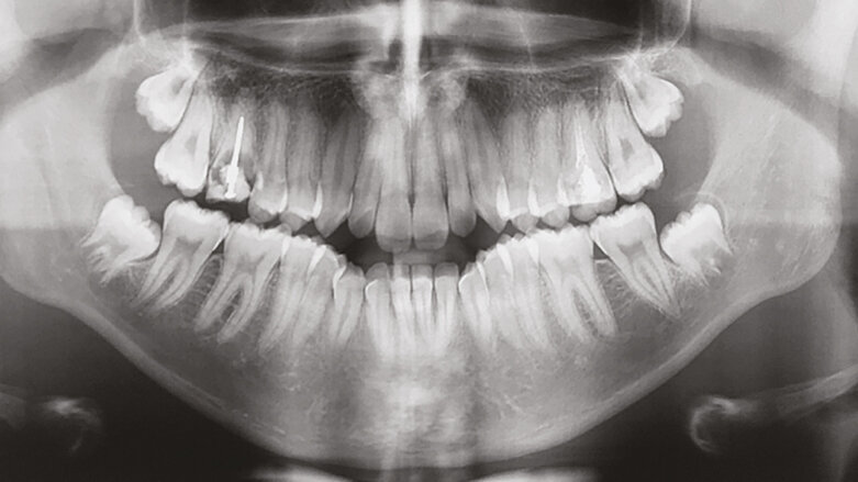 Stěsnání a protruze léčené nestandardními extrakcemi