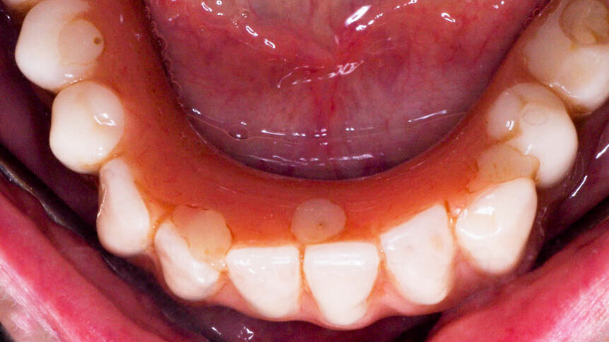 Surgical management of peri-implantitis