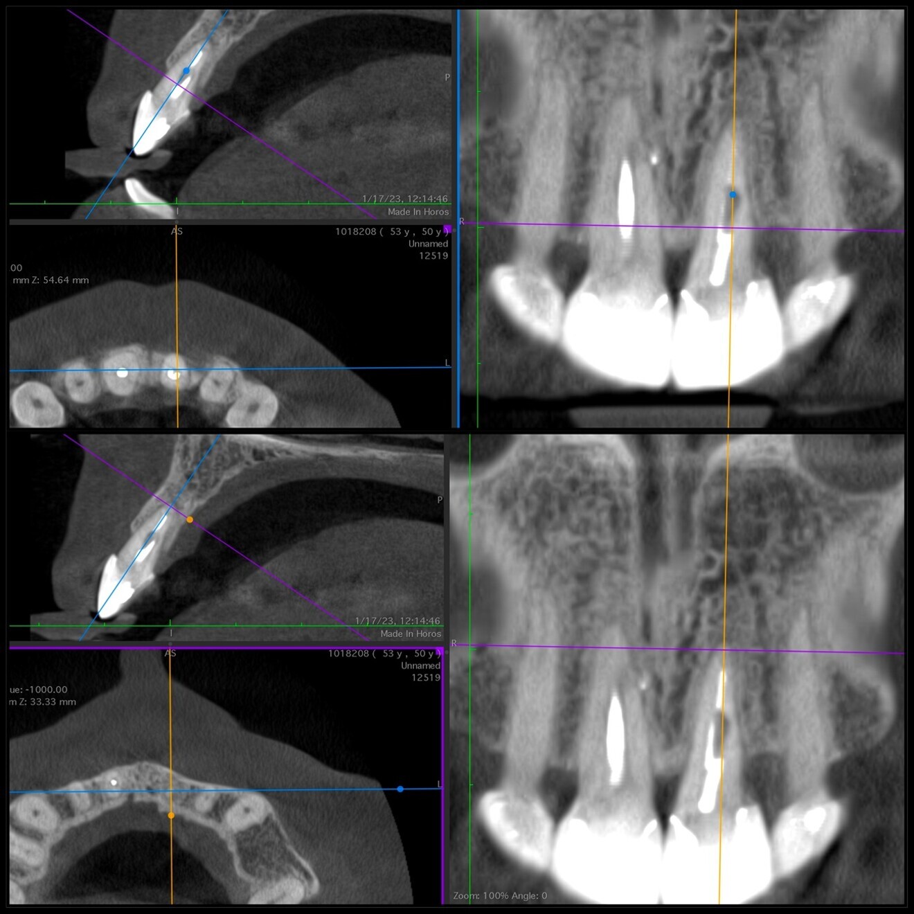 Fig 6: Two-year follow-up CBCT scan showing complete periapical healing, bone remodelling in the distal area and no signs of resorption. 