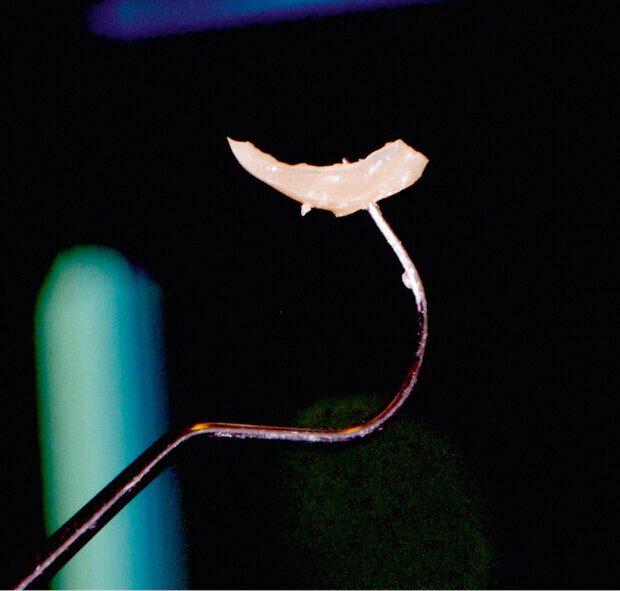 Fig. 9: Excess removal is easily achieved due to the new technology based on the Ivocerin photoinitiator