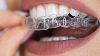 Streamlining clear aligner therapy–Success without attachments using the Progressive Smile Makeover Concept