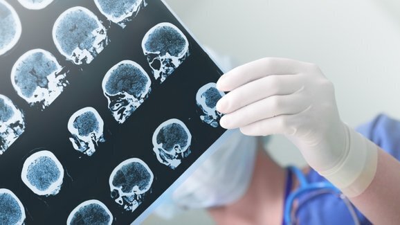 Falta de provas: Ligação entre saúde bucal e estado cognitivo permanece incerta