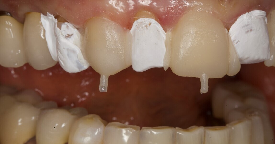 Fig. 13: Result after index removal.