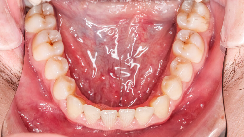 Study maps “tooth-making” mesenchymal cells on the lingual side