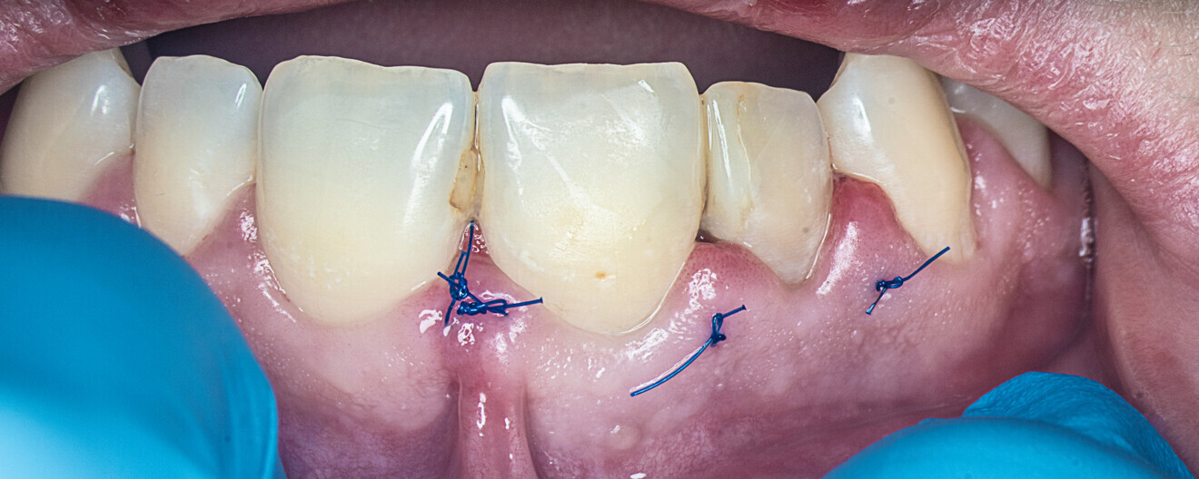 Fig. 15: Clinical situation after 14 days.