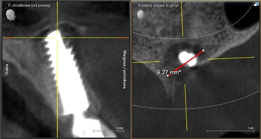 Fig. 14: Bone defect of 9.27mm in diameter.