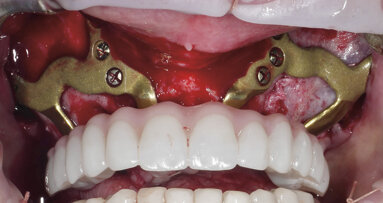 Quelle alternative à l’implantologie conventionnelle — implant zygomatique ou implant sous périosté ?