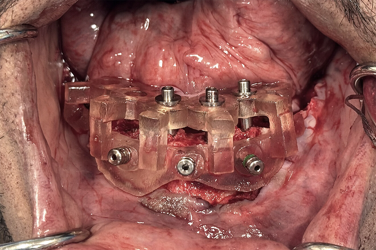 Fig. 16a: Intra-op retracted view of the surgical guide seated on the mandibular bone with three anchor pins and three guide stabilisers secured to the anterior implants.