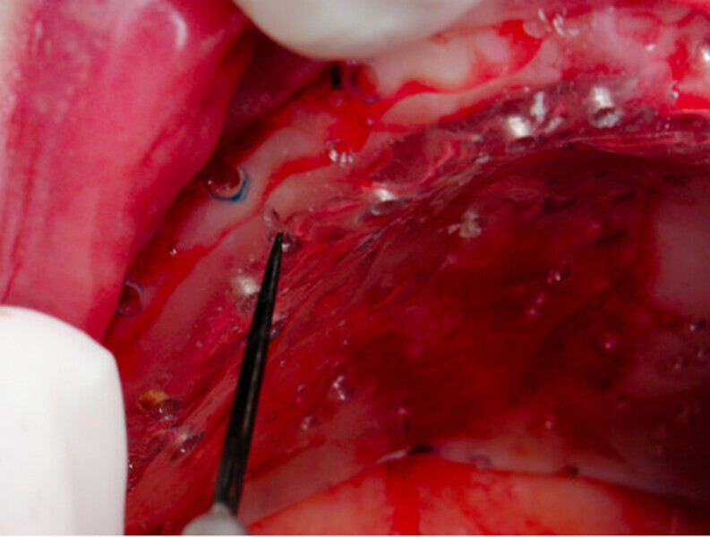 Fig. 5b : Trois séances d’ostéoactivation à 45 jours avec vérification de la densification à l’aide d’une plaque thermo formée. 